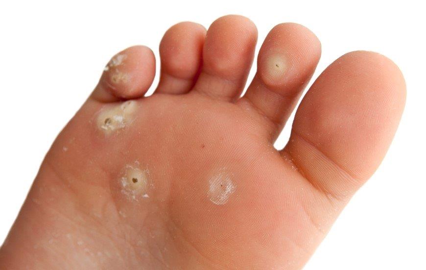 Wart Treatment Vancouver